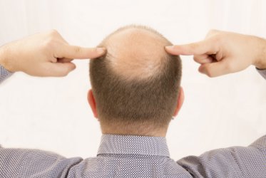 Injerto capilar: la solucin quirrgica para recuperar tu cabello