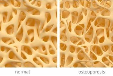 Osteoporosis: diagnstico y tratamiento