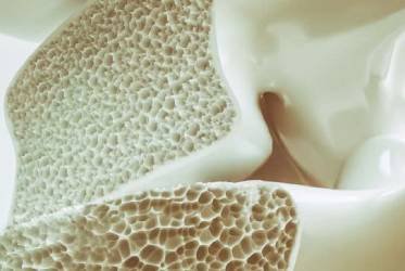 Osteoporosis: qu es, sntomas y cmo prevenirla